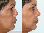 Before & After (id-1004) – Rhinoplasty (Revision)