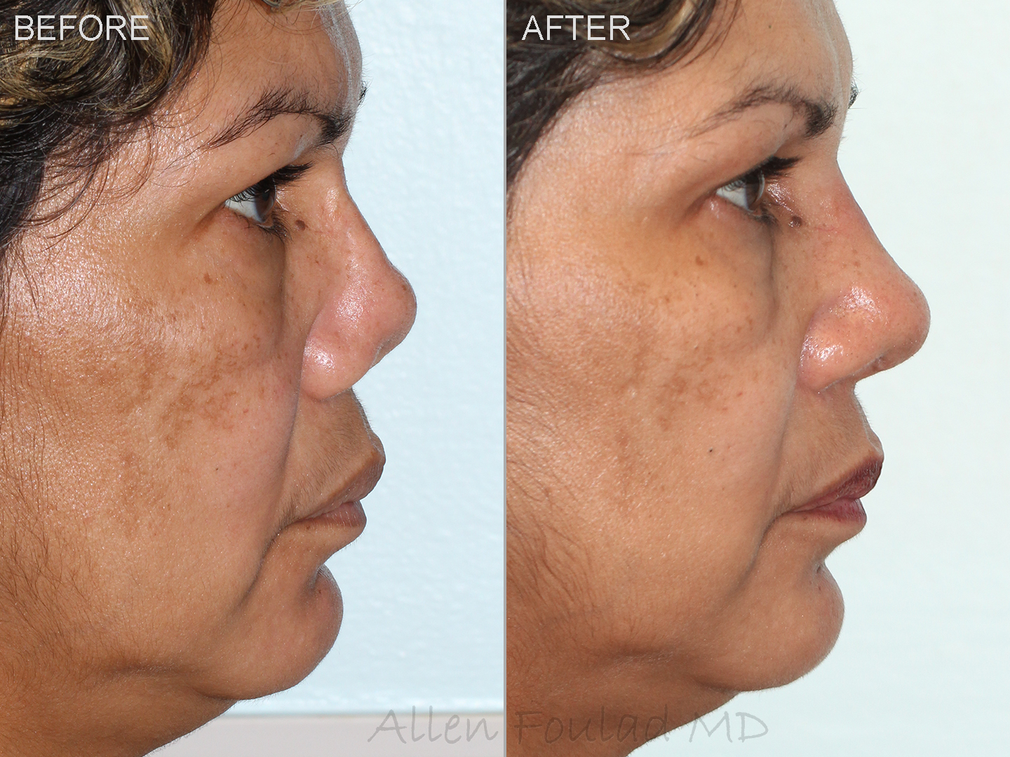 Nose Surgery Revision rhinoplasty - Upturned nose > Before & After Photo
