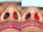 Rhinoplasty Before and After Photo by Allen Foulad MD in Beverly Hills, CA