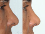 Before & After (id-1003) – Rhinoplasty (Revision)