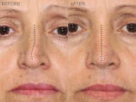 Before & After (id-1002) – Rhinoplasty (Trauma)