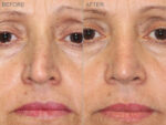 Before & After (id-1002) – Rhinoplasty (Trauma)