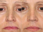 Before & After (id-1002) – Rhinoplasty (Trauma)