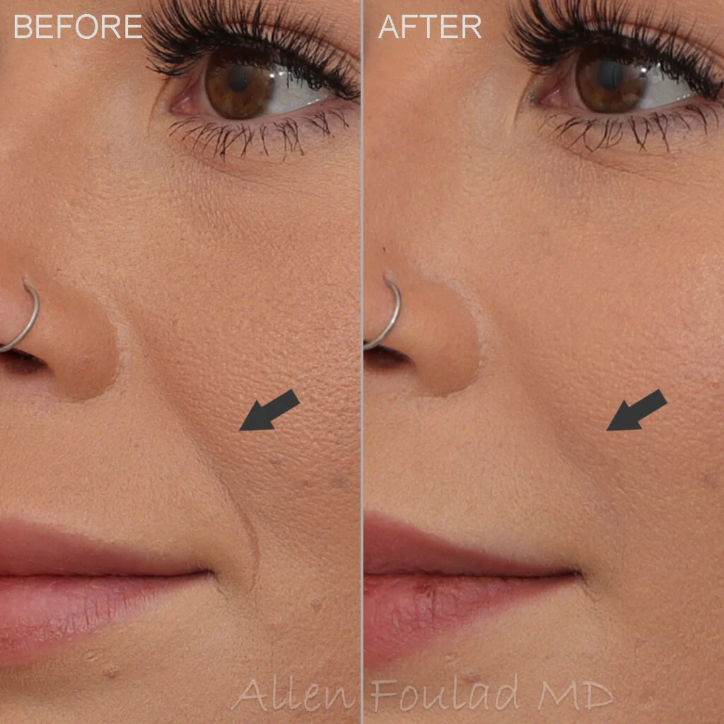 Before and after smile line filler treatment. Laugh lines have been reduced in young woman.