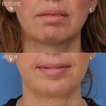 Before & After (id-1014) – Neuromodulators (Chin Botox)