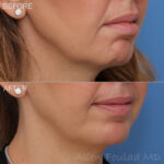 Before & After (id-1014) – Neuromodulators (Chin Botox)