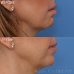 Before & After (id-1014) – Neuromodulators (Chin Botox)