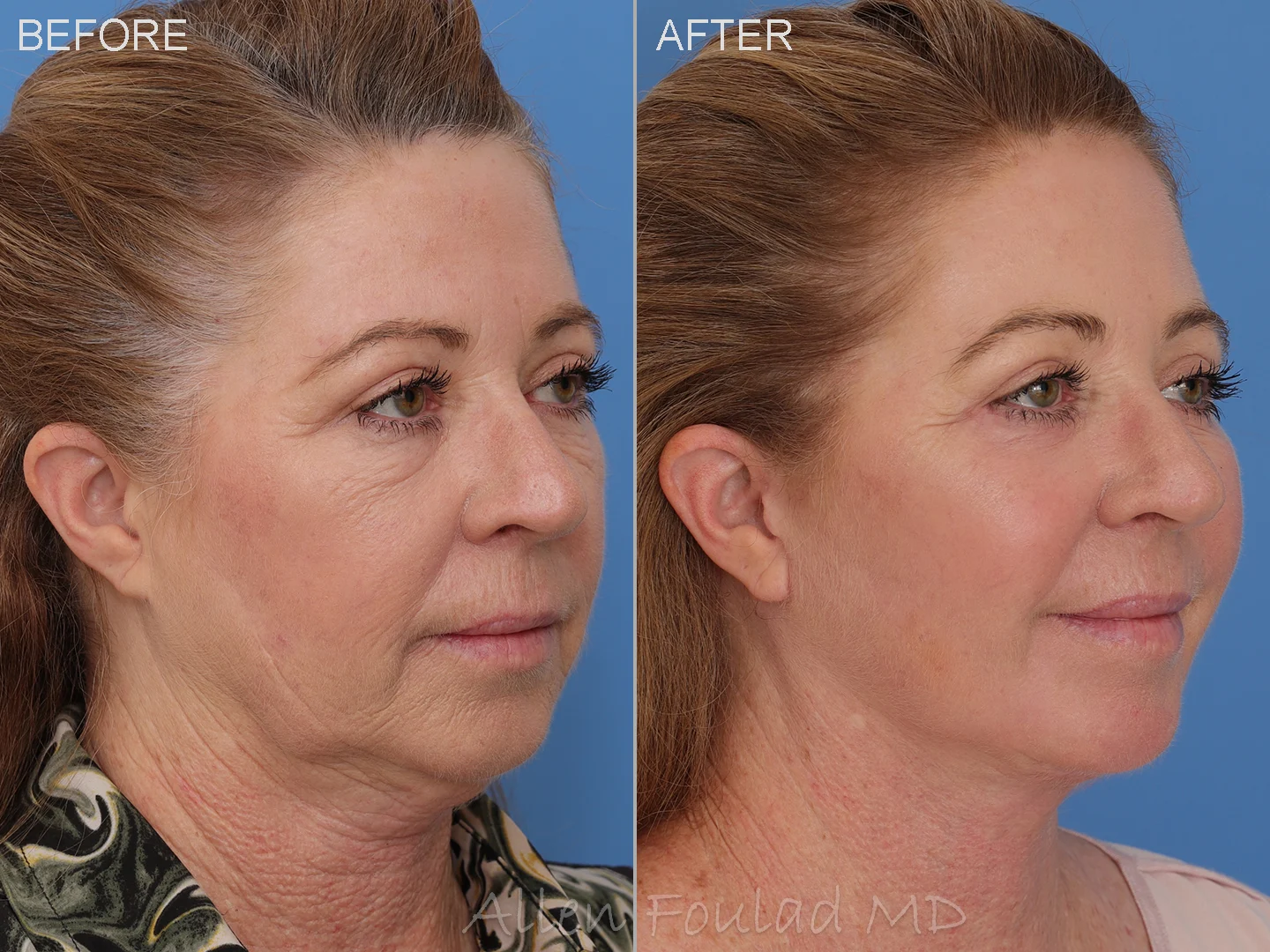 Facelift & Neck Lift Before and After Photo by Allen Foulad MD in Beverly Hills, CA