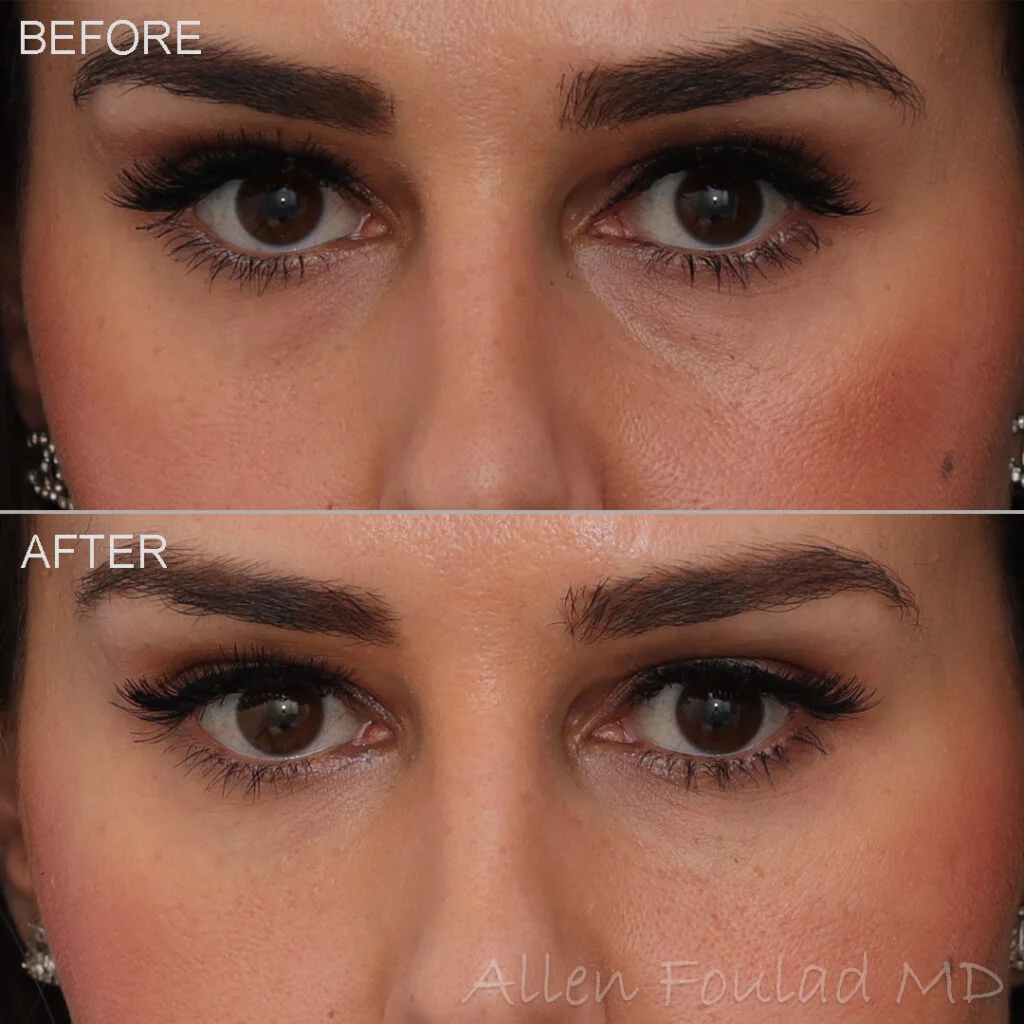 Before and after tear trough filler treatment. Contour of the under eye region is improved.