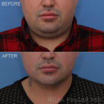 Before & After (id-1016) – Liposuction of Neck