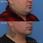 Before & After (id-1016) – Liposuction of Neck