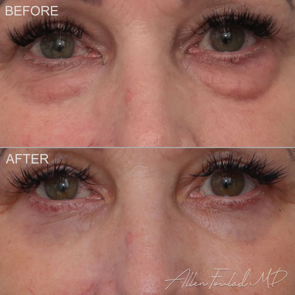 Before and after Lower Eyelid Surgery, on patient.