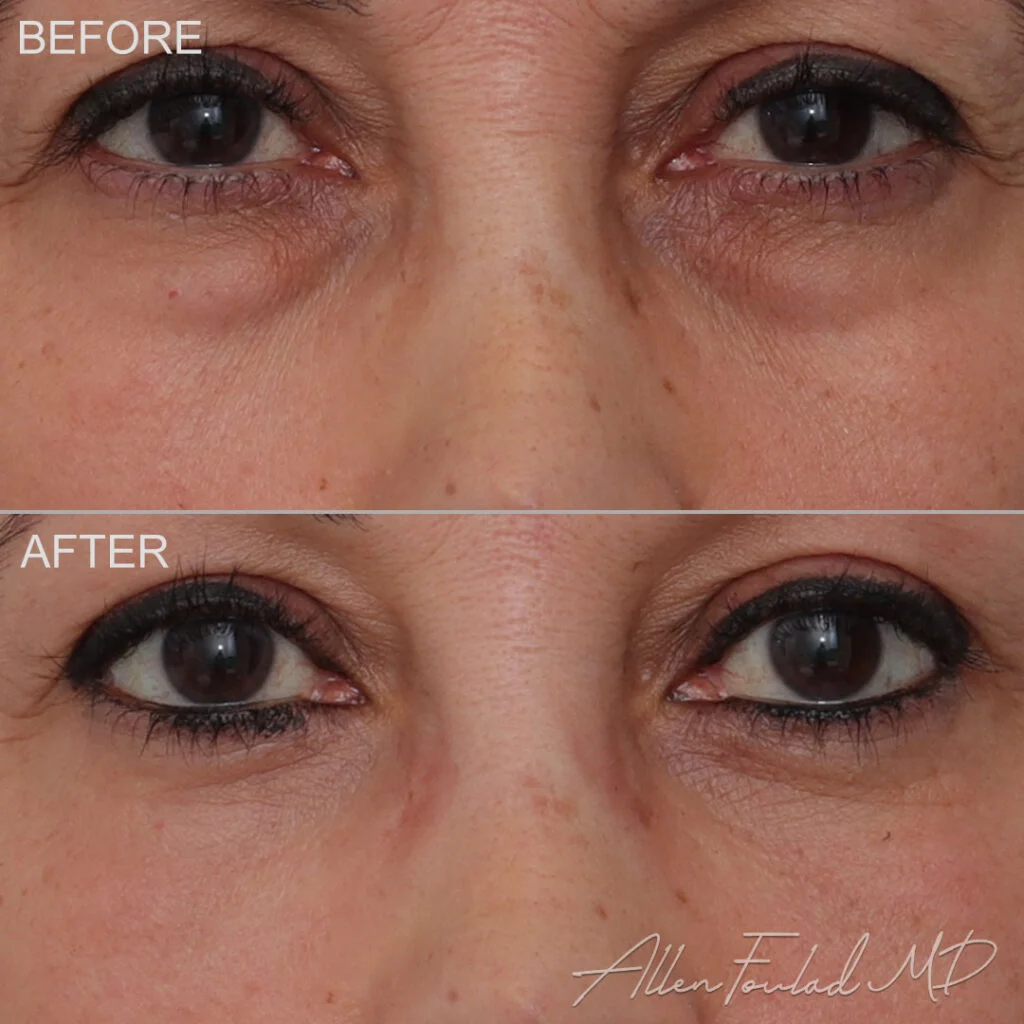 Before and after Lower Eyelid Surgery, on patient.