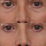 Before & After (id-1048) - Lower Eyelid Surgery