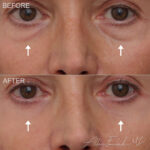 Before & After (id-1048) - Lower Eyelid Surgery