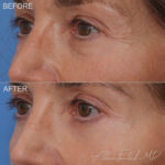 Before & After (id-1048) - Lower Eyelid Surgery