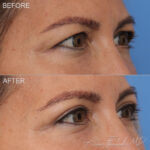 Before & After (id-1038) – Upper Eyelid Surgery