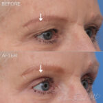 Before & After (id-1039) – Upper Eyelid Surgery