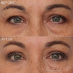 Before & After (id-1040) – Upper Eyelid Surgery