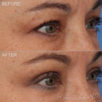 Before & After (id-1040) – Upper Eyelid Surgery