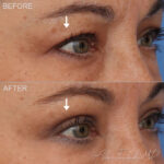 Before & After (id-1040) – Upper Eyelid Surgery