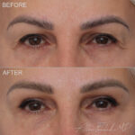 blepharoplasty-upper-eyelid-3-f