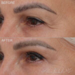 Before & After (id-1031) – Upper Eyelid Surgery