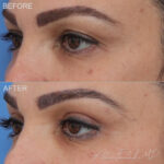 Before & After (id-1034) – Upper Eyelid Surgery