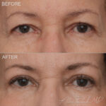 Before & After (id-1036) – Upper Eyelid Surgery