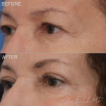 Before & After (id-1036) – Upper Eyelid Surgery