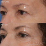 Before & After (id-1036) – Upper Eyelid Surgery