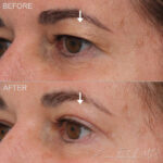 Before & After (id-1037) – Upper Eyelid Surgery