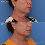 Before & After (id-1070) – Facelift and Neck Lift