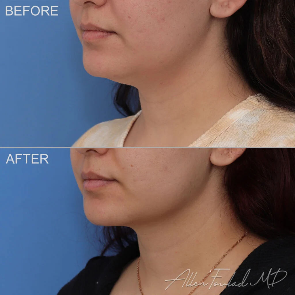 Before and after Liposuction of Face and Neck, on female patient.