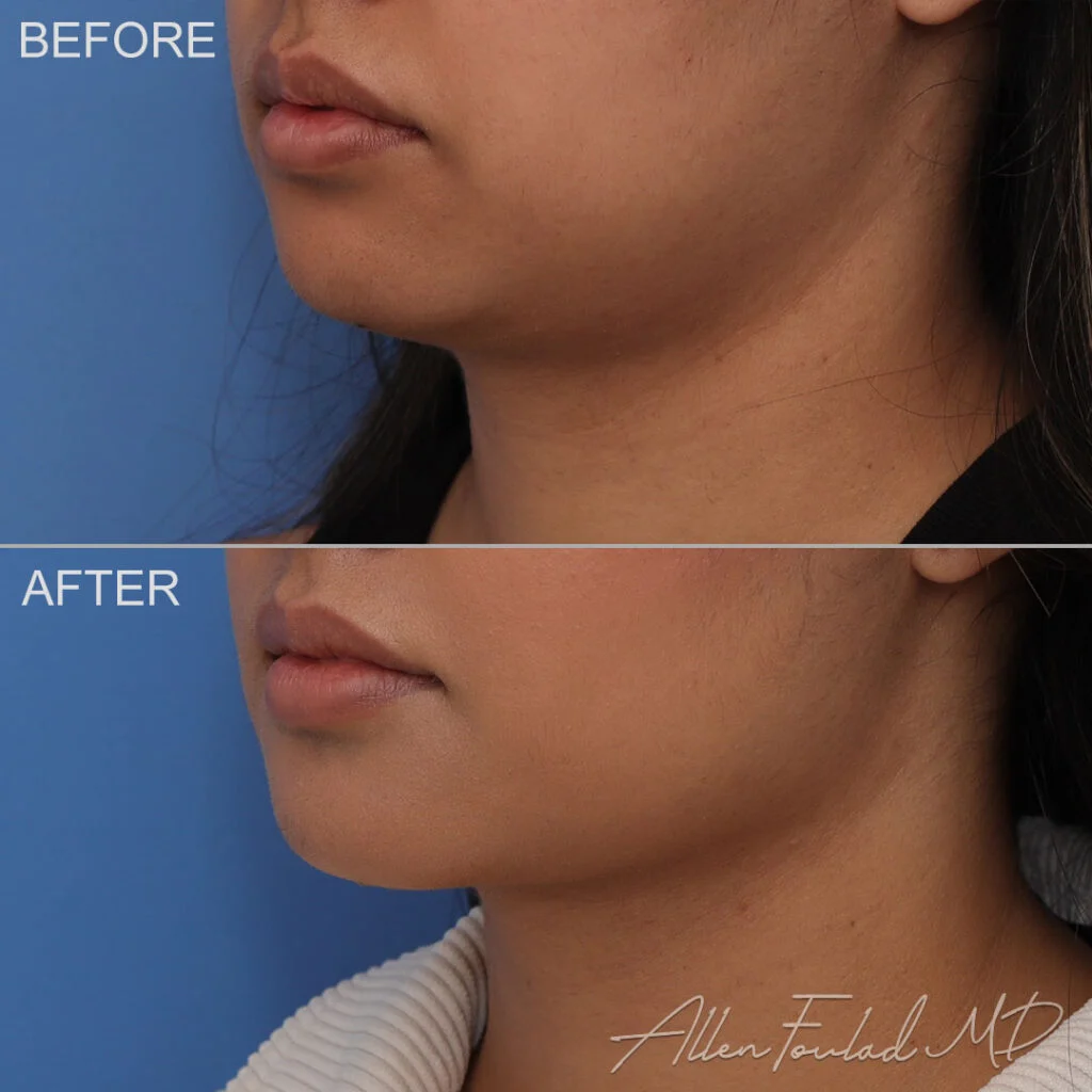 Before and after Liposuction of Face and Neck, on female patient.