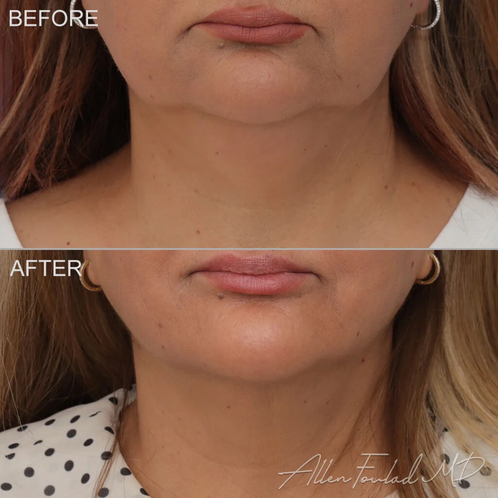 Before and after Liposuction of Face and Neck, on female patient.