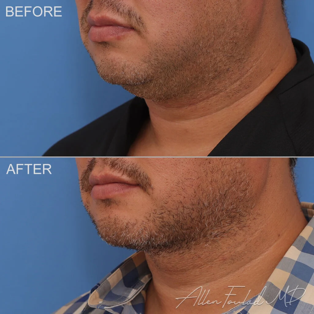 Before and after Liposuction of Face and Neck, on male patient.