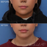 Before & After (id-1062) – Liposuction of Face and Neck