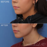 Before & After (id-1062) – Liposuction of Face and Neck