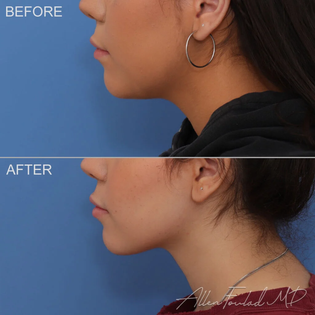 Before and after Liposuction of Face and Neck, on female patient.