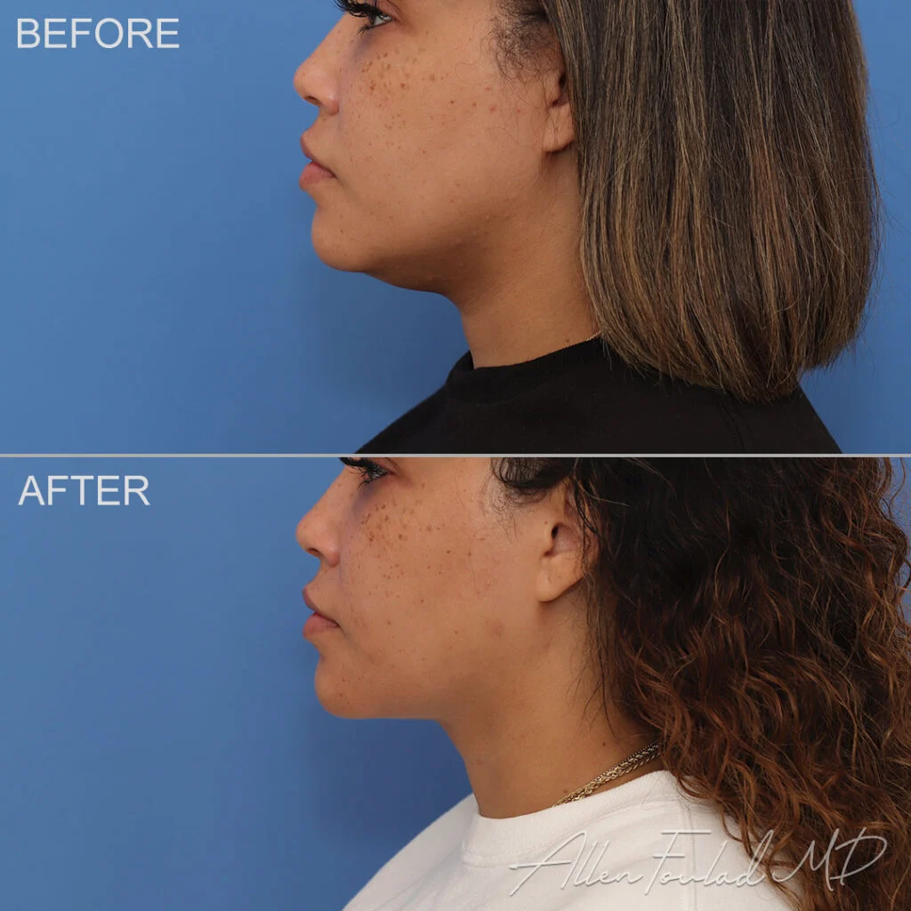 Before and after Liposuction of Face and Neck, on female patient.