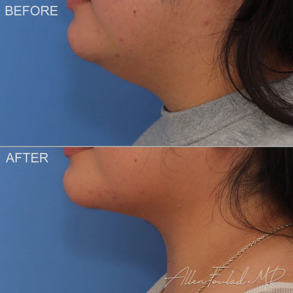 Before and after Liposuction of Face and Neck, on female patient.