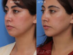 Before & After (id-1074) – Chin Implant