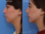 Before & After (id-1074) – Chin Implant