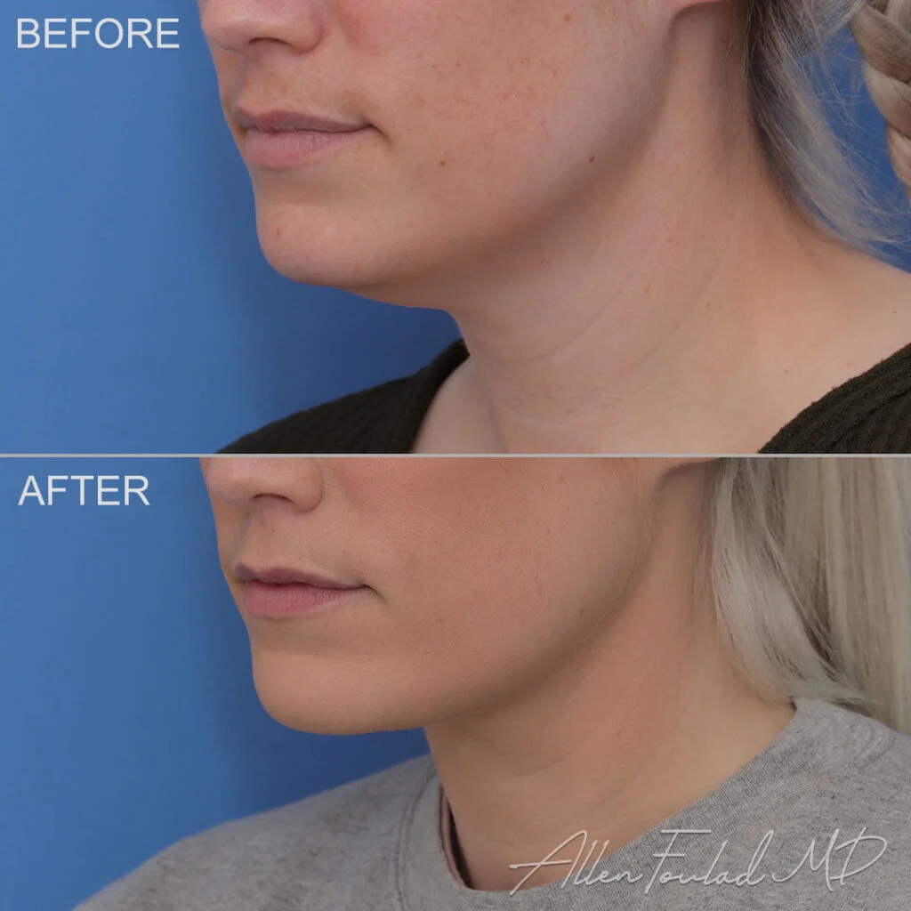 Before and after Minimal Incision Deep Sculpting Neck Lift, on female patient