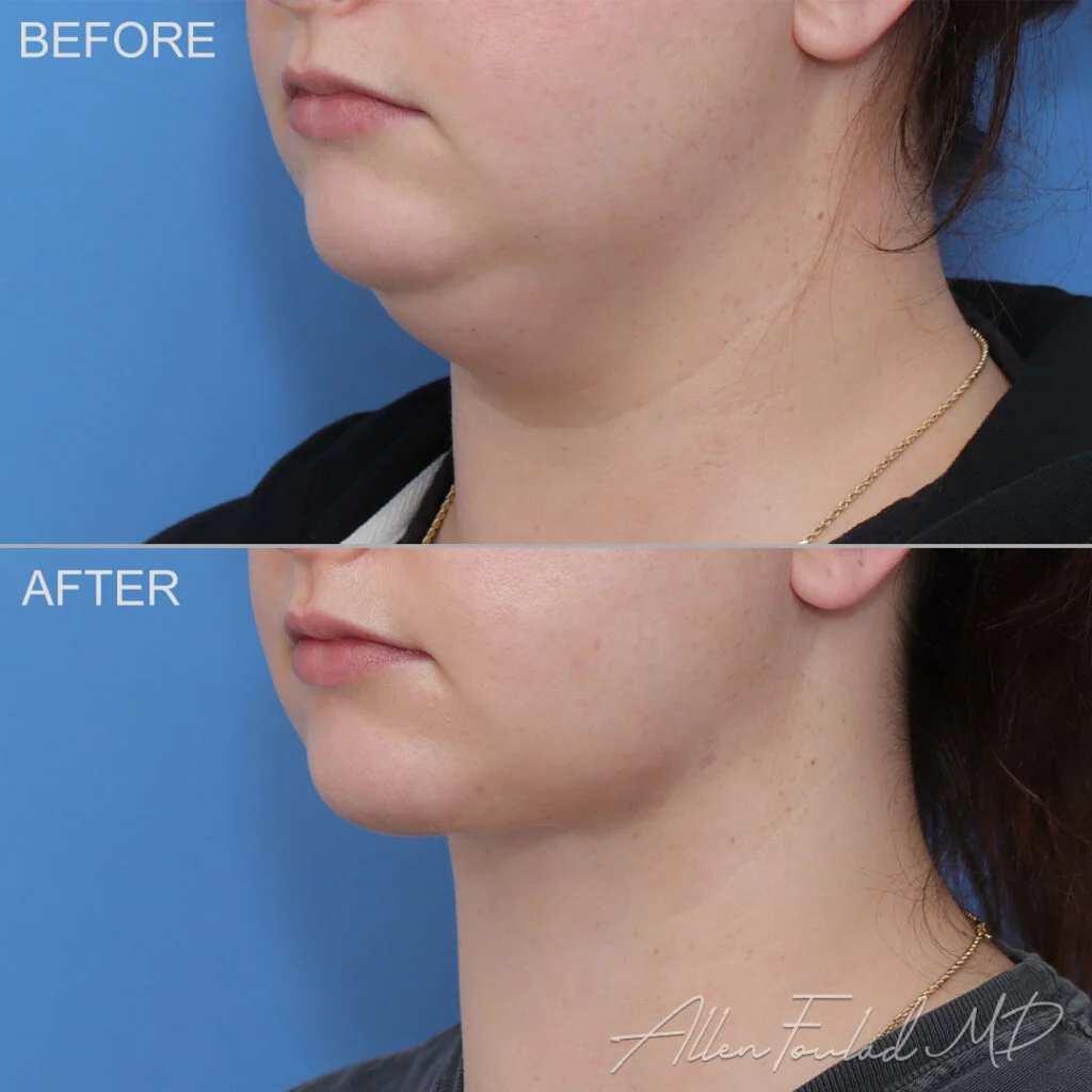 Before and after Minimal Incision Deep Sculpting Neck Lift, on female patient