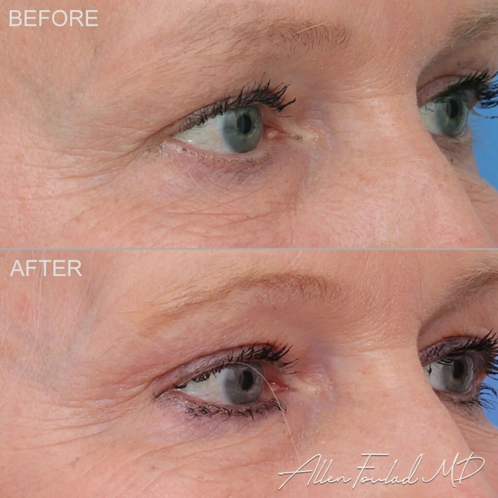 Before and after Lateral Temporal Brow Lift, on female patient