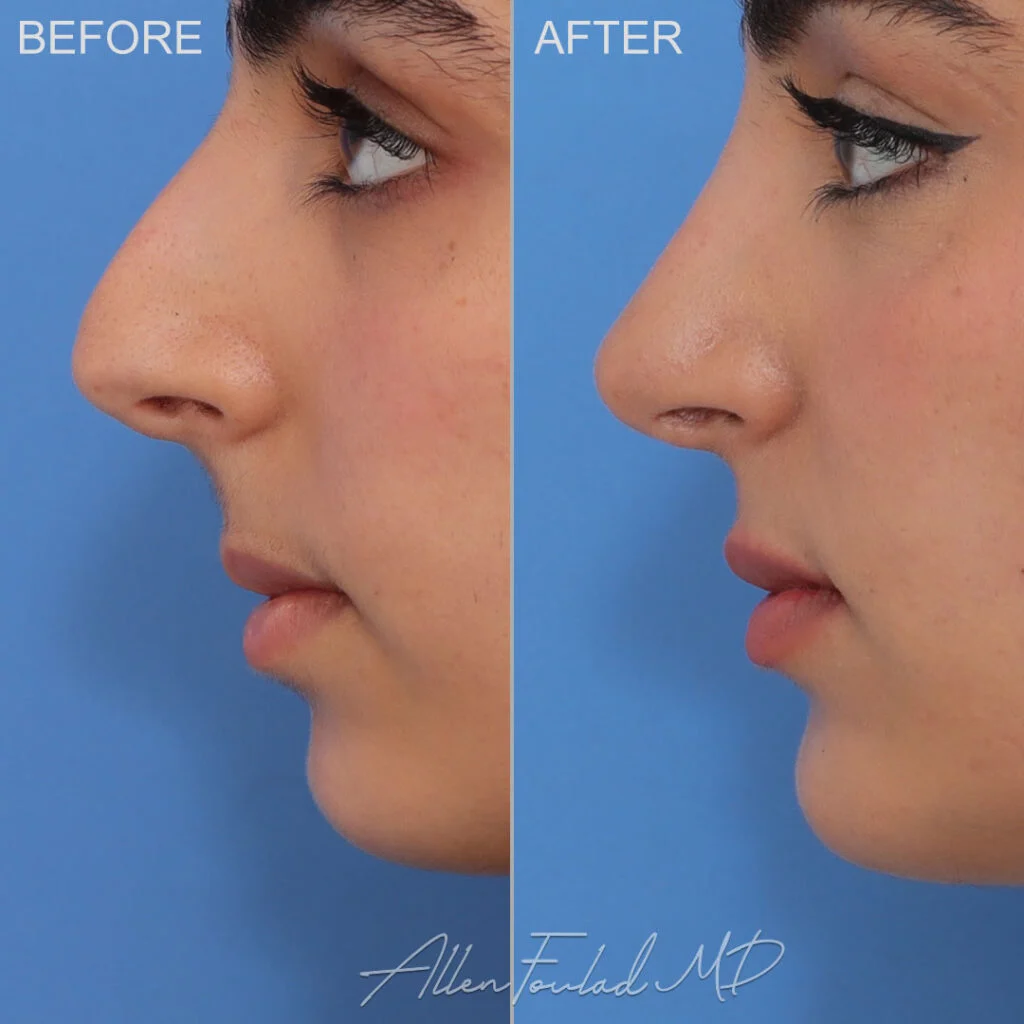 Before and After photo of an extended anatomical chin implant by Allen Foulad, MD