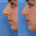 Before and After photo of an extended anatomical chin implant by Allen Foulad, MD