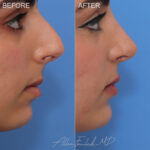 Before and After photo of an extended anatomical chin implant by Allen Foulad, MD